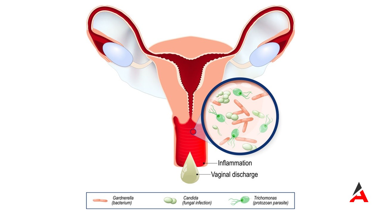 Vajinal Enfeksiyonlar Yaygın Türler Ve Tedavi Seçenekleri