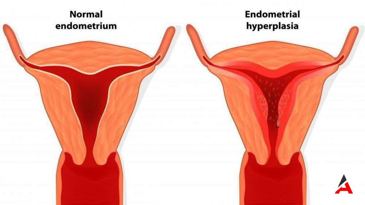 Rahim Duvarı Neden Kalınlaşır? Hormonal Dengesizlikler ve Obezite Riskleri!